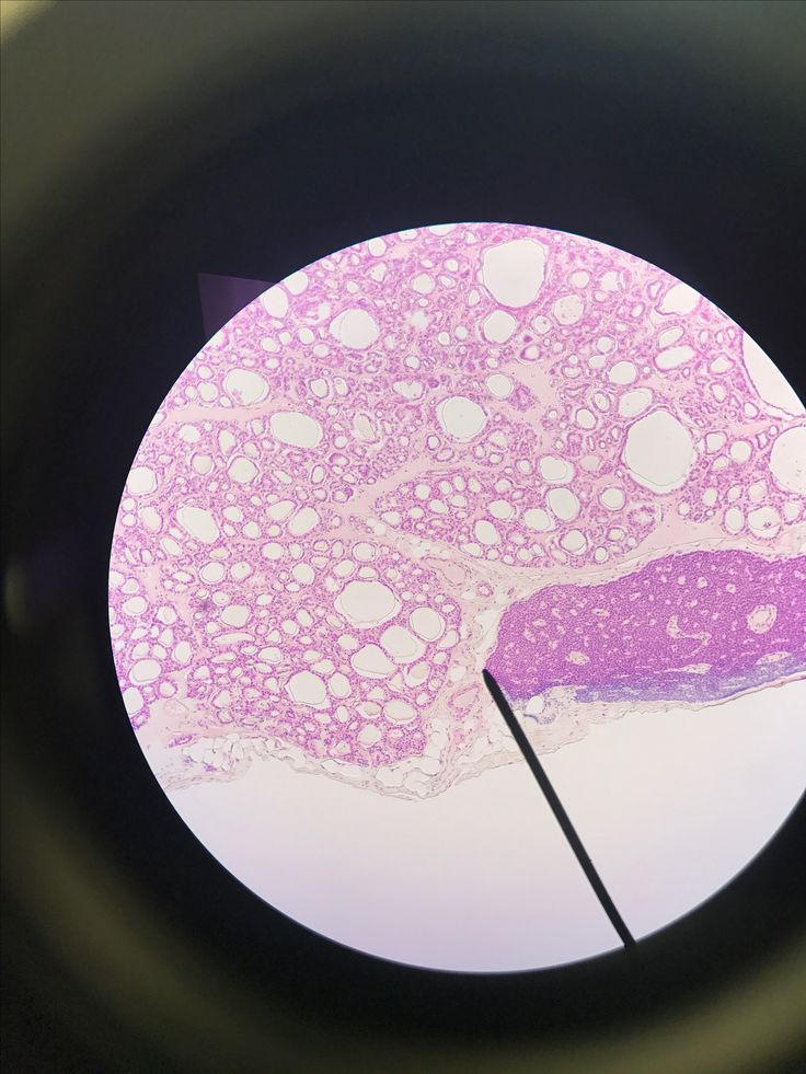 parathyroid