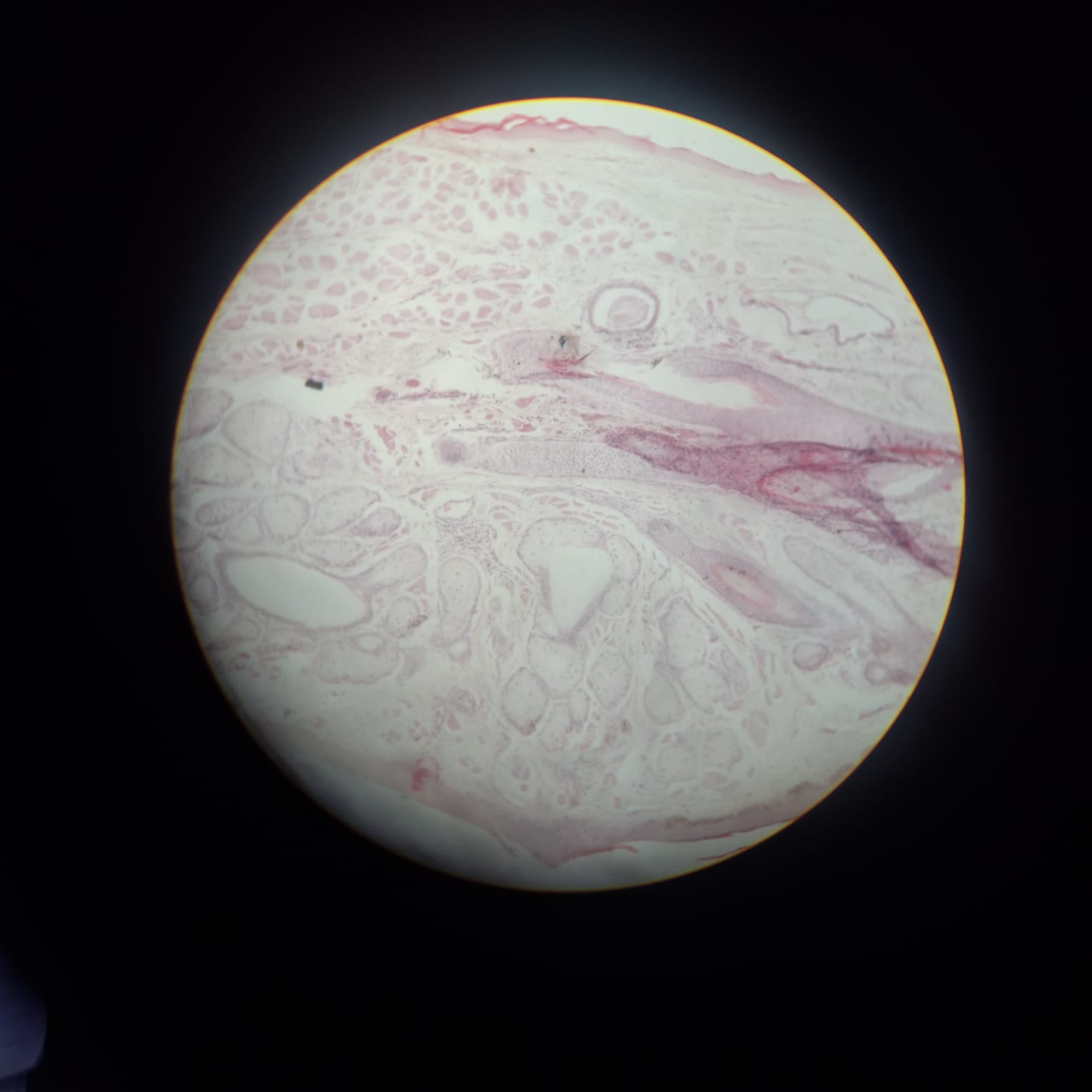 Eyelid