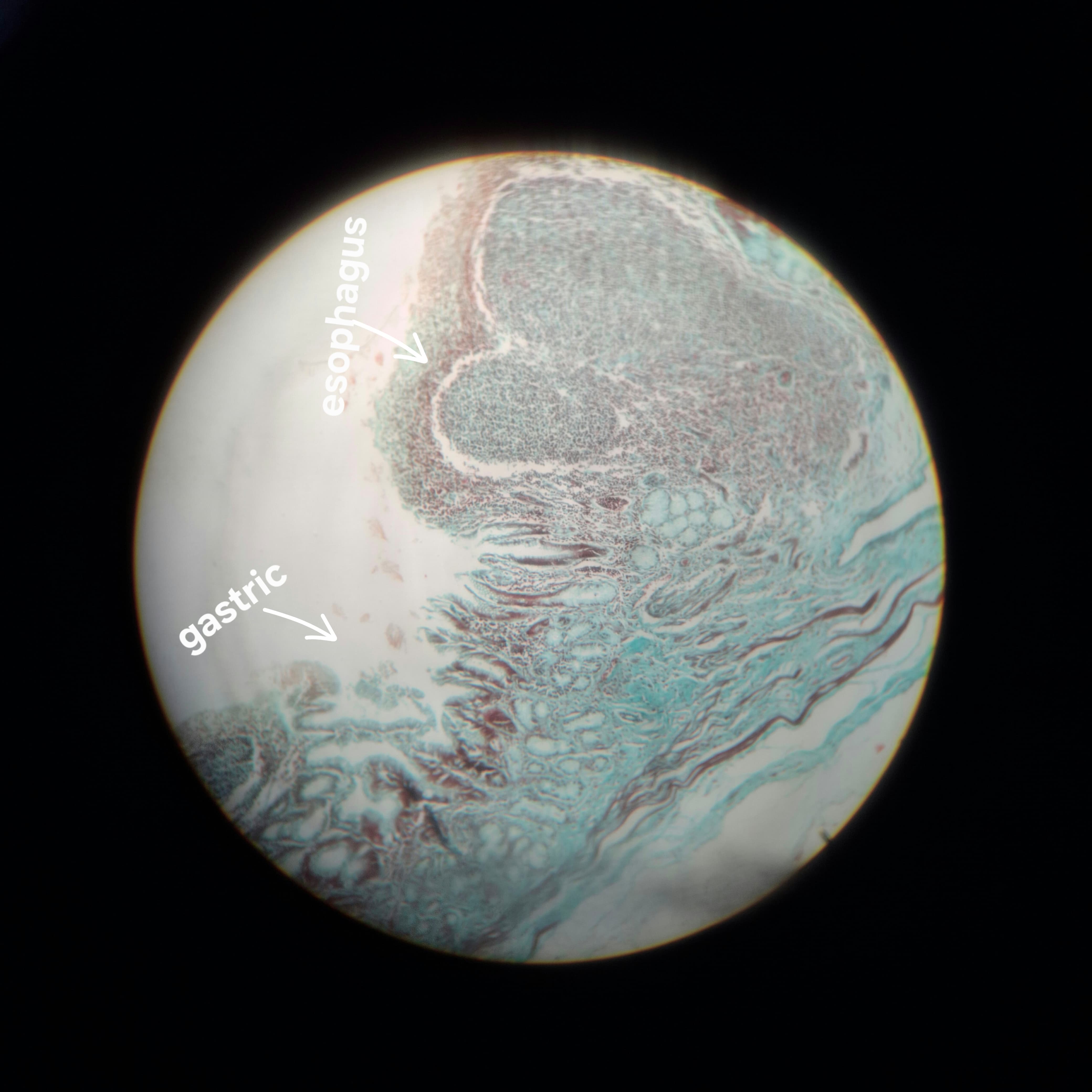 Gastro-Esophageal Junction
