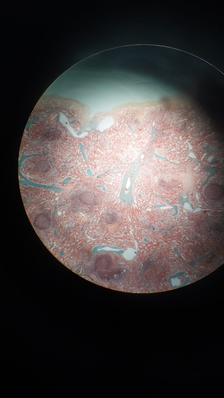 Spleen