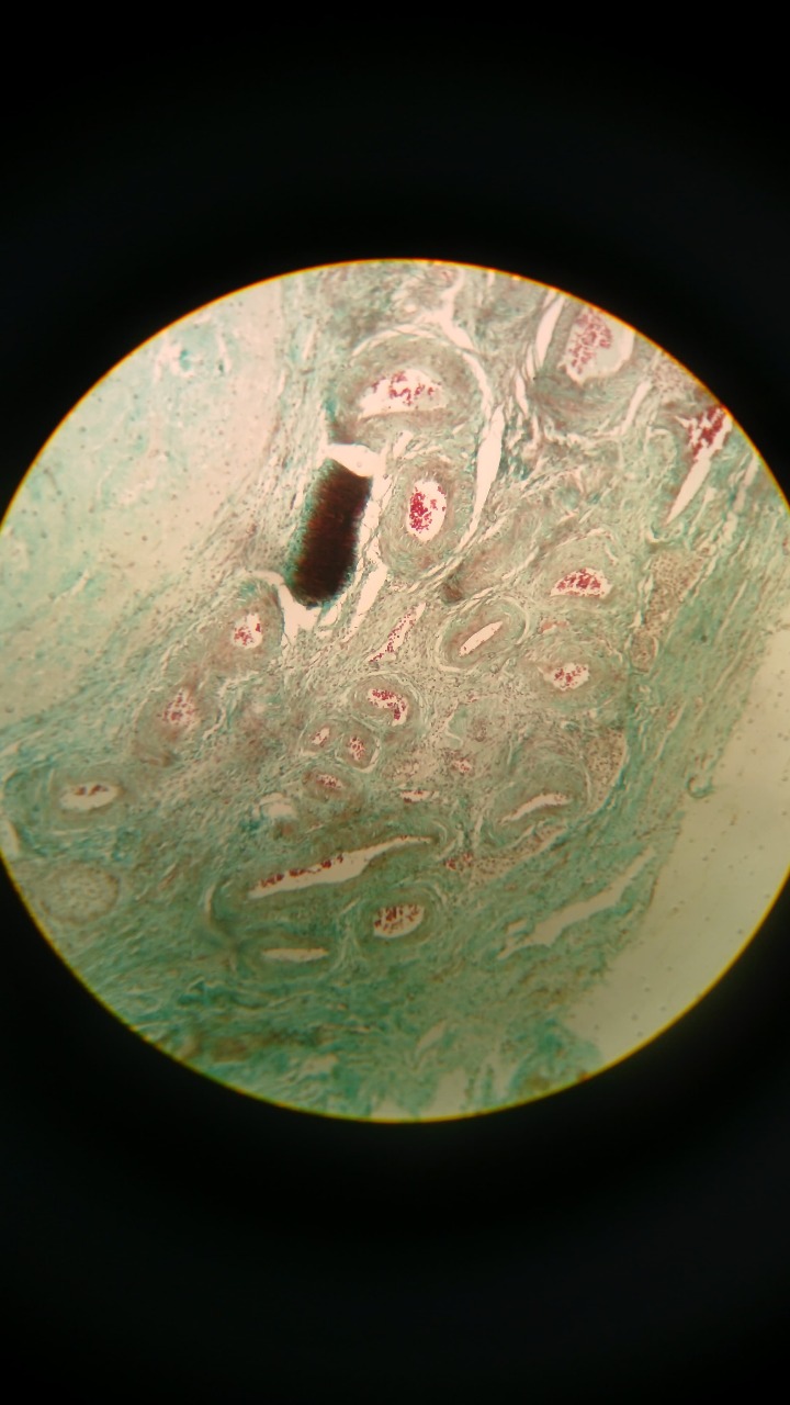 Bladder